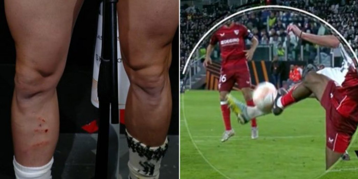 เห็นแผลมั้ย? ‘ราบิโอต์’ โอดเปาควรให้จุดโทษ ‘ม้าลาย’