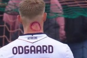 โดนซอมบี้กัด?! ‘อ๊อดการ์ด’ แจงรอยแดงหลังคอ